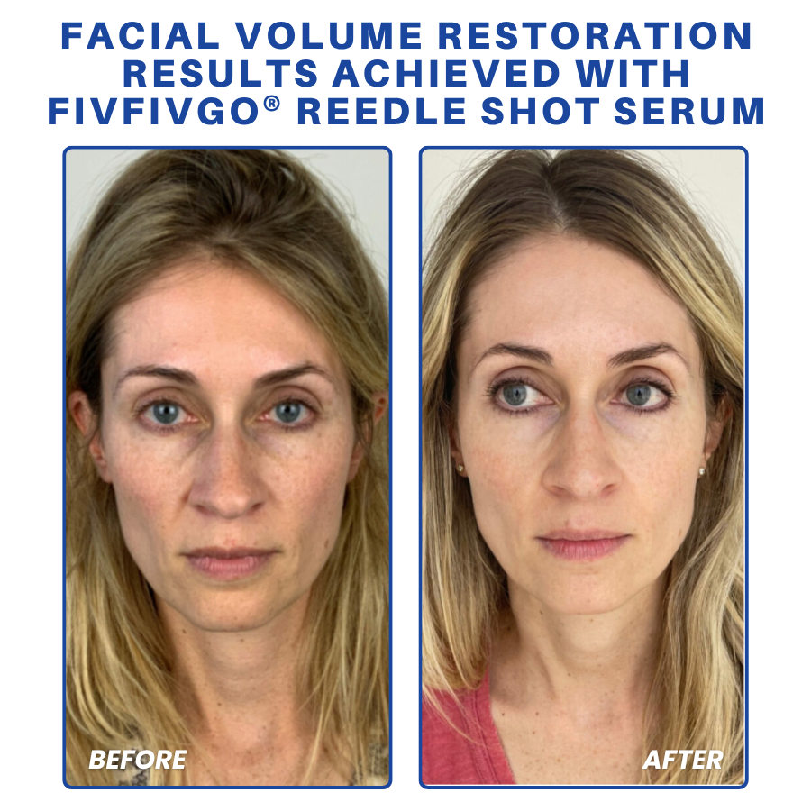 Fivfivgo® PDRN-NAD+ Cica Reedle Shot Serum 19 Fivfivgo® PDRN-NAD+ Cica Reedle Shot Serum