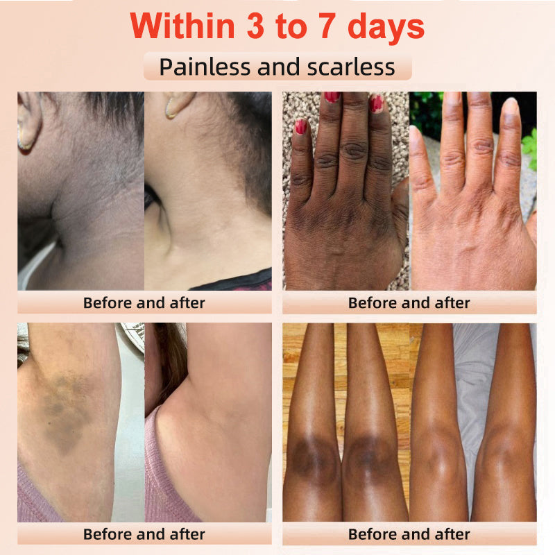 Fivfivgo™ Purifying Exfoliating Gel for Acanthosis Nigricans, Exfoliation, Dark Spots, Skin Tags, and Eczema