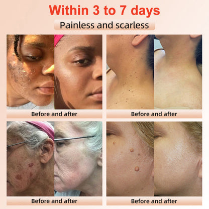 Fivfivgo™ Purifying Exfoliating Gel for Acanthosis Nigricans, Exfoliation, Dark Spots, Skin Tags, and Eczema