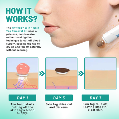 Fivfivgo™ 2-in1 Skin Tag Removal Kit