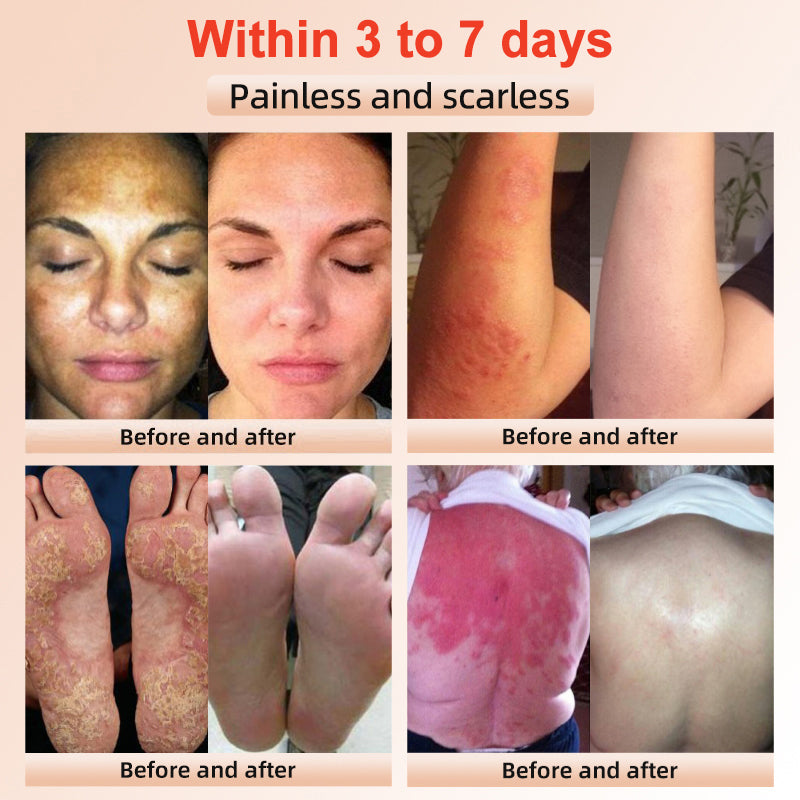 Fivfivgo™ Purifying Exfoliating Gel for Acanthosis Nigricans, Exfoliation, Dark Spots, Skin Tags, and Eczema