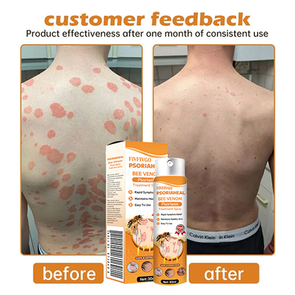 Fivfivgo™ PsoriaHeal Bee Venom Psoriasis Treatment Spray(Suitable for all skin conditions)