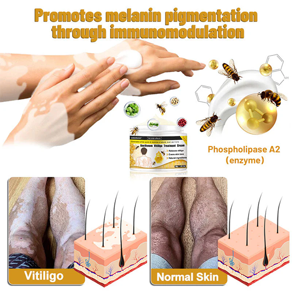 Fivfivgo™ Bee Venom Vitiligo Treatment Cream