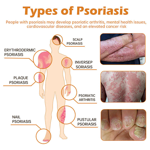 Fivfivgo™ PsoriaHeal Bee Venom Psoriasis Treatment Spray(Suitable for all skin conditions)