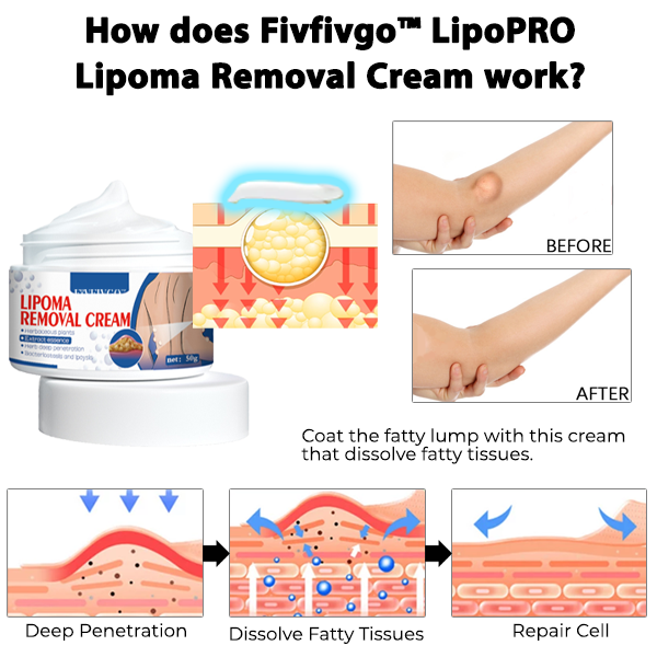 Fivfivgo™ LipoPRO Lipoma Removal Cream