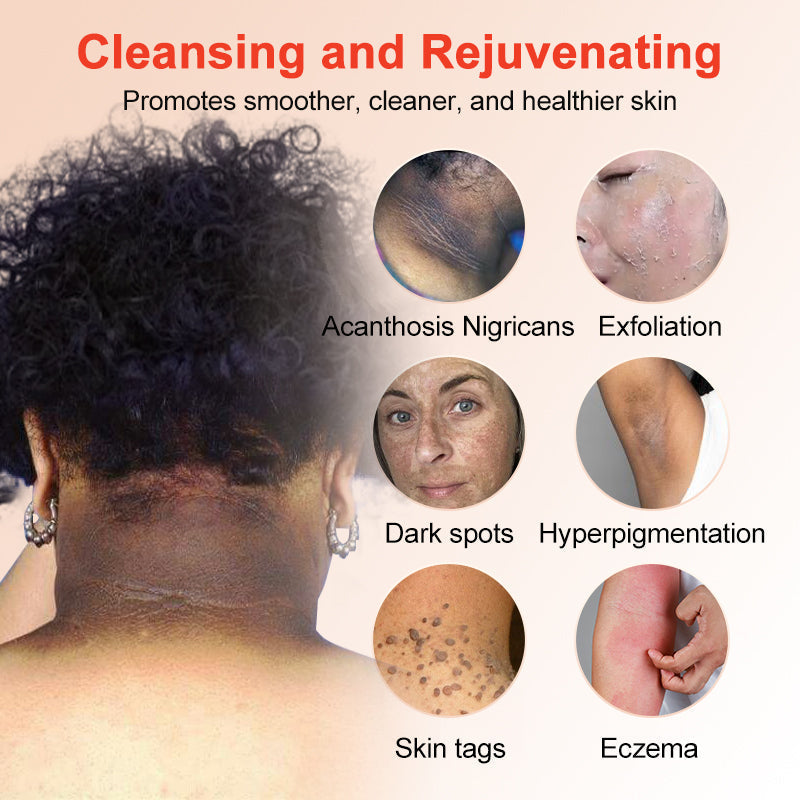 Fivfivgo™ Purifying Exfoliating Gel for Acanthosis Nigricans, Exfoliation, Dark Spots, Skin Tags, and Eczema