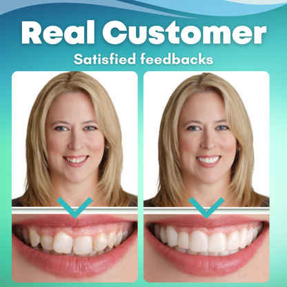 Fivfivgo™ SnapOn Silicone Veneers - your perfect smile awaits you! 🦷 Limited time 50% discount!