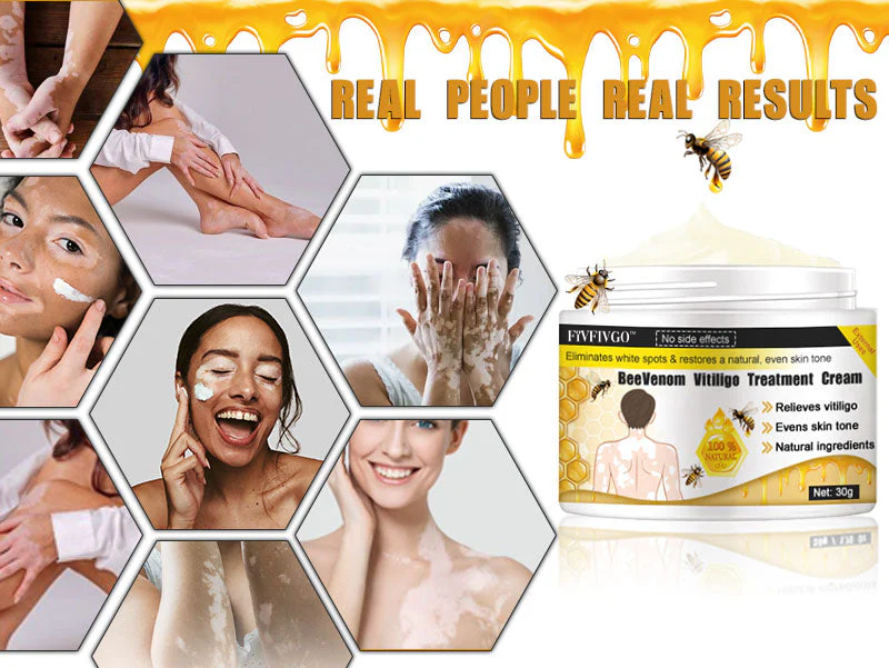 Fivfivgo™ Bee Venom Vitiligo Treatment Cream