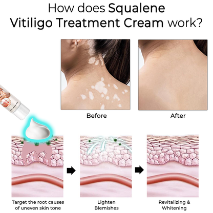 Fivfivgo™ Squalene Vitiligo Treatment Cream