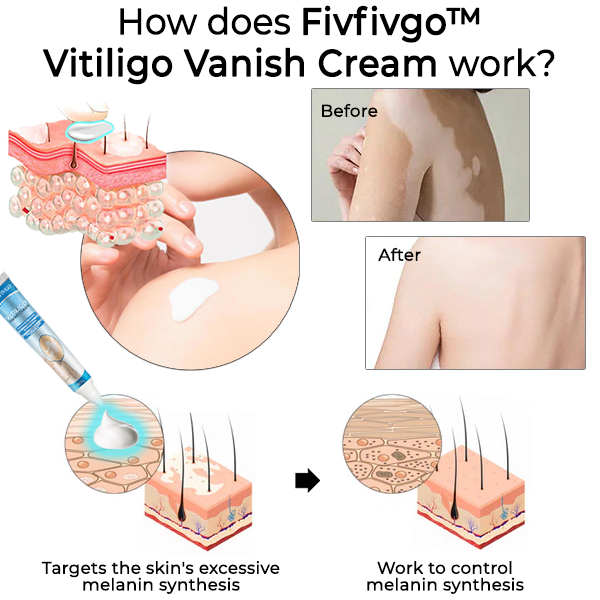 Fivfivgo™ Vitiligo Vanish Cream