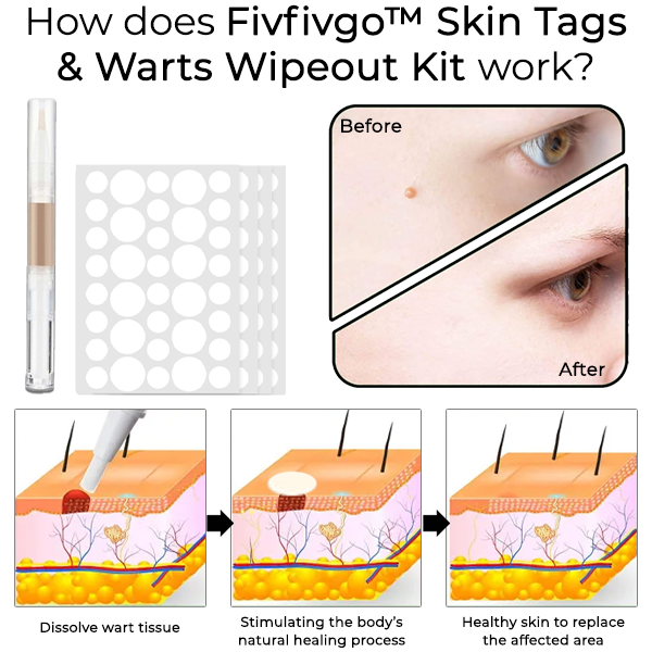 Fivfivgo™ Skin Tags & Warts Wipeout Kit