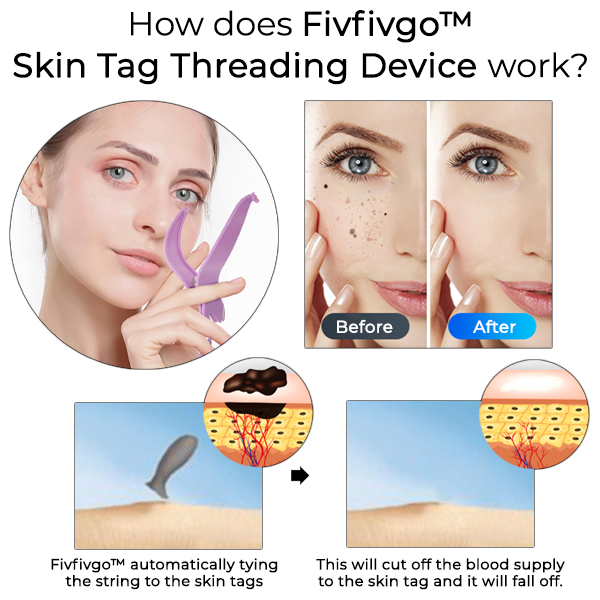 Fivfivgo™ Skin Tag Threading Device