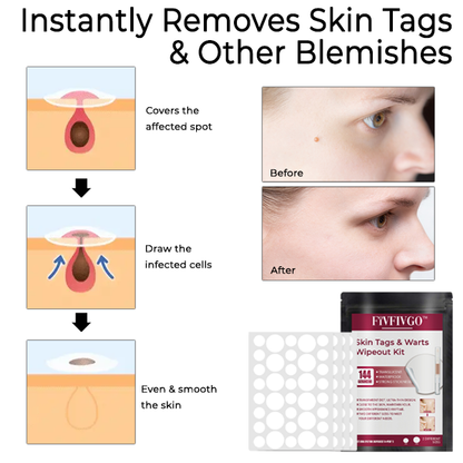 Fivfivgo™ Skin Tags & Warts Wipeout Kit