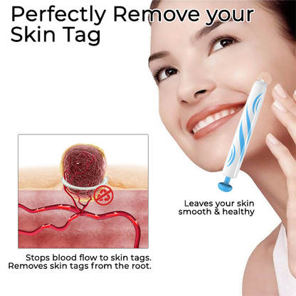 Fivfivgo™ At-home Skin Tag Removal Pen