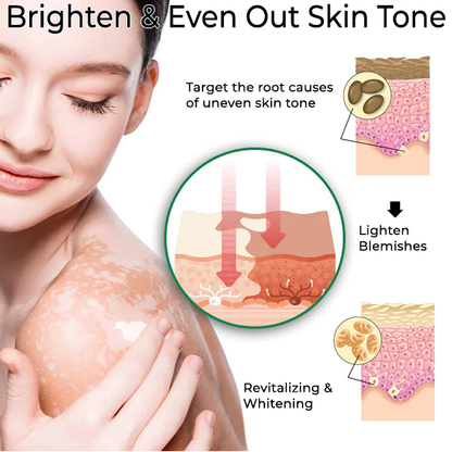 Fivfivgo™ Vitiligo Vanish Cream