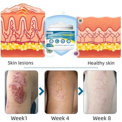 Fivfivgo™ Multi-Symptom Psoriasis Treatment Cream