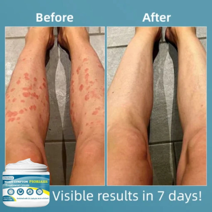 Fivfivgo™ Multi-Symptom Psoriasis Treatment Cream