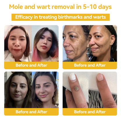 Fivfivgo™ BeeVenom Mole & Wart Treatment Cream