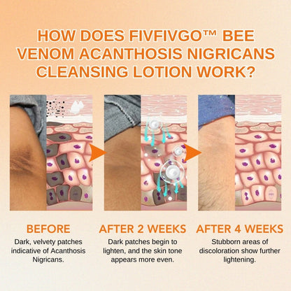 Fivfivgo™ Bee Venom Acanthosis Nigricans Cleansing Lotion