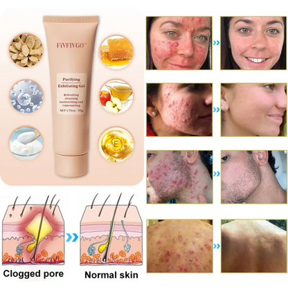 Fivfivgo™ Purifying Exfoliating Gel for Acanthosis Nigricans, Exfoliation, Dark Spots, Skin Tags, and Eczema