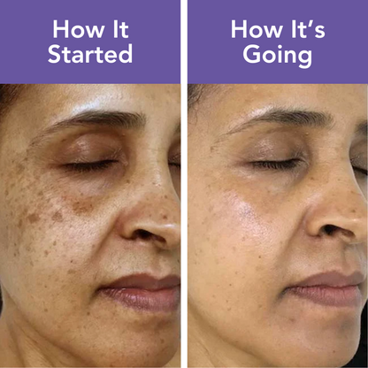 Fivfivgo™ Age Spots Removal Patches