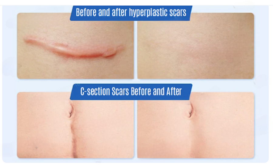 Fivfivgo™ SilkScar Scar Treatment & Skin Repair Serum