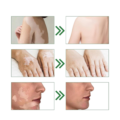 Fivfivgo™ Squalene Vitiligo Treatment Cream