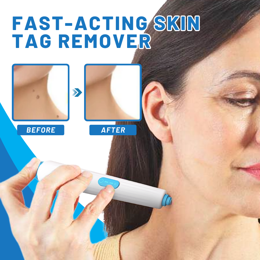 Fivfivgo™ At-home Skin Tag Threading Pen